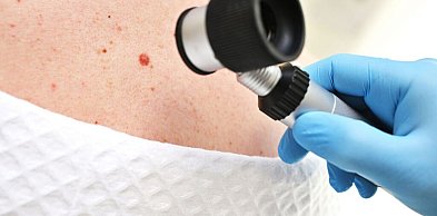 Kiedy znamię skórne wymaga oceny – praktyczne kryteria kwalifikacji do diagnostyki