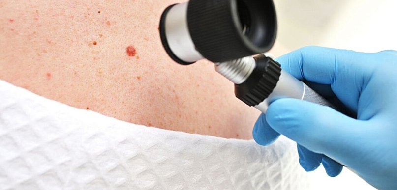 Kiedy znamię skórne wymaga oceny – praktyczne kryteria kwalifikacji do diagnostyki