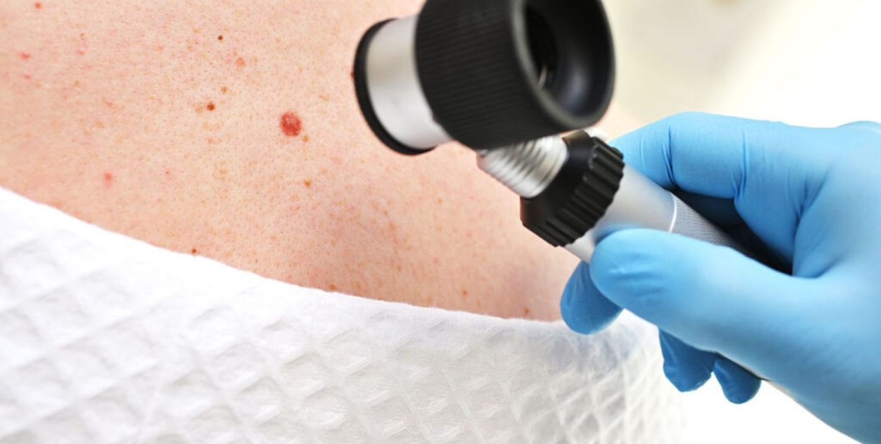 Kiedy znamię skórne wymaga oceny – praktyczne kryteria kwalifikacji do diagnostyki